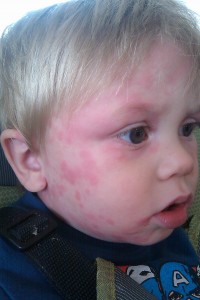 Rash 2